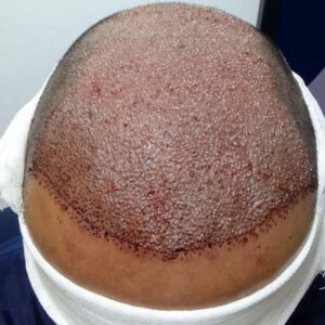 کاشت تخصصی مو و ابرو و ریش