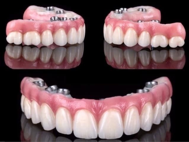 مرکز تخصصی ایمپلنت دیجیتال
